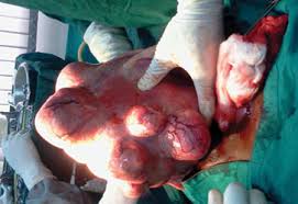 fibroid