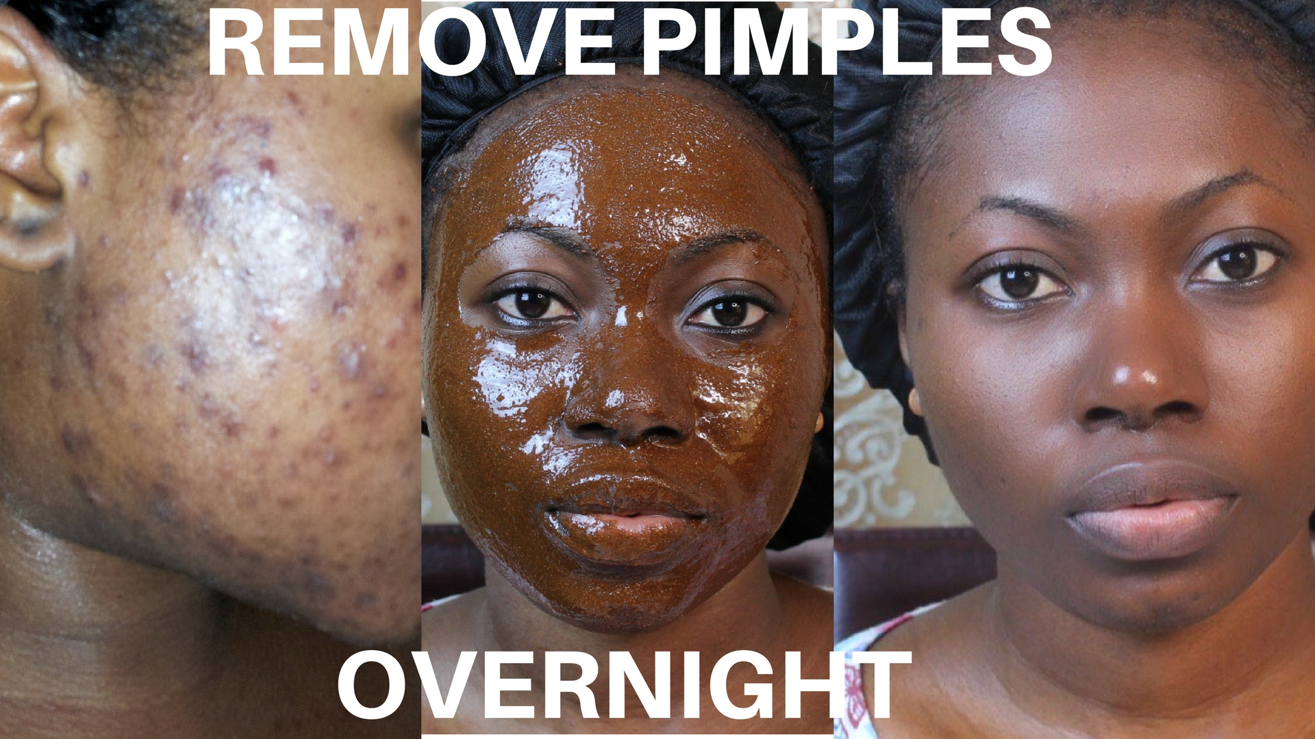 Pimples